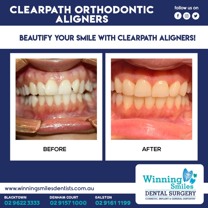before and after Clearpath Orthodontic aligners