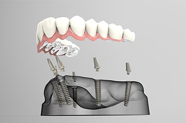 How-Painful-are-Dental-Implants-Procedure (1)